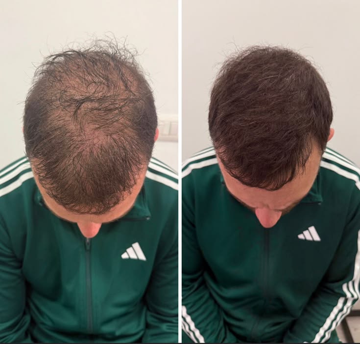 Haartransplantation Transformation 2